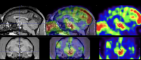 MRI and PET images of LCN2 hormone in brain of non-human primate
